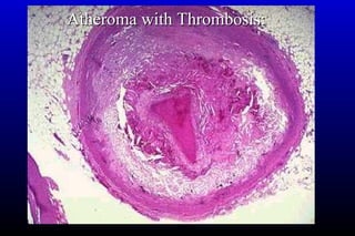 Atheroma with Thrombosis:Atheroma with Thrombosis:
 