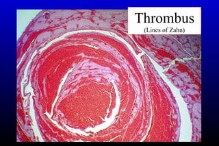 Thrombus
(Lines of Zahn)
 