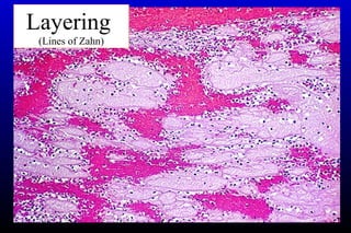 Layering
(Lines of Zahn)
 