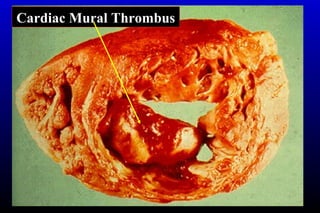 Cardiac Mural Thrombus
 