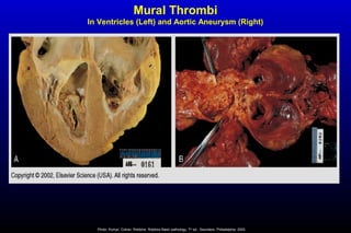 Mural Thrombi
In Ventricles (Left) and Aortic Aneurysm (Right)
Photo: Kumar, Cotran, Robbins. Robbins Basic pathology, 7th
ed., Saunders, Philadelphia, 2003.
 
