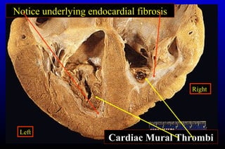 Cardiac Mural Thrombi
Notice underlying endocardial fibrosis
Right
Left
 