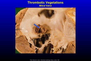 Thrombotic Vegetations
Mitral Valve
Photo: Stevens A, Lowe J. Slide atlas of pathology. Mosby, London, 1995.
 
