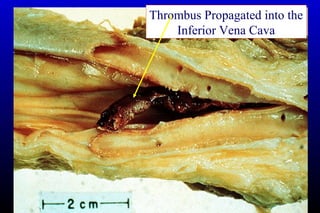 Thrombus Propagated into the
Inferior Vena Cava
 