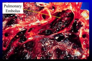 Pulmonary
Embolus
 