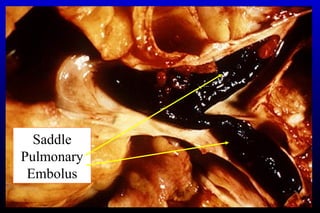 Saddle
Pulmonary
Embolus
 