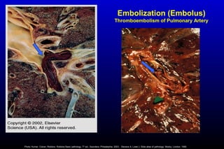 Embolization (Embolus)
Thromboembolism of Pulmonary Artery
Photo: Kumar, Cotran, Robbins. Robbins Basic pathology, 7th
ed., Saunders, Philadelphia, 2003; . Stevens A, Lowe J. Slide atlas of pathology. Mosby, London, 1995.
 