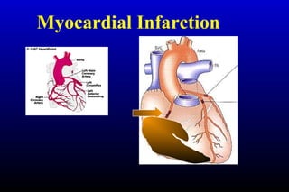 Myocardial Infarction
 