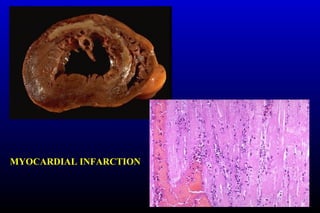 MYOCARDIAL INFARCTION
 