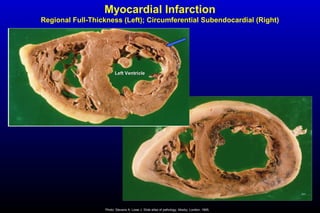 Myocardial Infarction
Regional Full-Thickness (Left); Circumferential Subendocardial (Right)
Photo: Stevens A, Lowe J. Slide atlas of pathology. Mosby, London, 1995.
Left VentricleLeft Ventricle
 