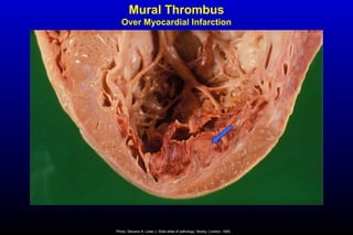 Mural Thrombus
Over Myocardial Infarction
Photo: Stevens A, Lowe J. Slide atlas of pathology. Mosby, London, 1995.
 