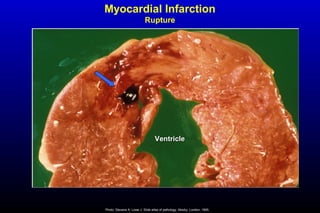 Myocardial Infarction
Rupture
Photo: Stevens A, Lowe J. Slide atlas of pathology. Mosby, London, 1995.
VentricleVentricle
 