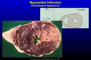 Myocardial Infarction
Chronological Appearance
Photo: Stevens A, Lowe J. Slide atlas of pathology. Mosby, London, 1995.
 