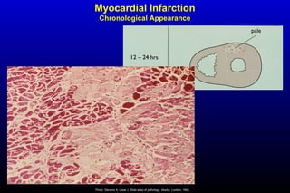 Myocardial Infarction
Chronological Appearance
Photo: Stevens A, Lowe J. Slide atlas of pathology. Mosby, London, 1995.
 
