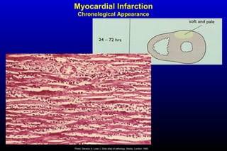 Myocardial Infarction
Chronological Appearance
Photo: Stevens A, Lowe J. Slide atlas of pathology. Mosby, London, 1995.
 