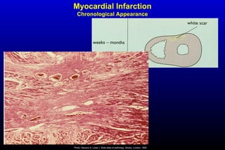 Myocardial Infarction
Chronological Appearance
Photo: Stevens A, Lowe J. Slide atlas of pathology. Mosby, London, 1995.
 