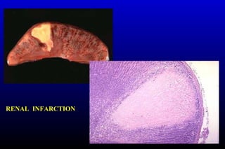 RENAL INFARCTION
 