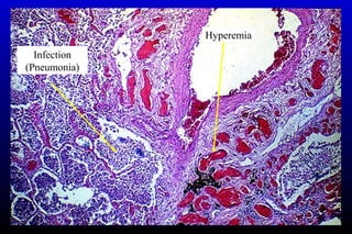 Hyperemia in PneumoniaHyperemia
Infection
(Pneumonia)
 