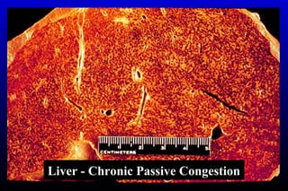 Liver - Chronic Passive Congestion
 