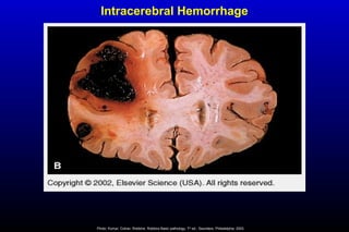 Intracerebral Hemorrhage
Photo: Kumar, Cotran, Robbins. Robbins Basic pathology, 7th
ed., Saunders, Philadelphia, 2003.
 