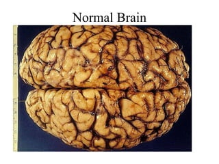 Normal Brain

 