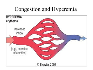 Congestion and Hyperemia

 
