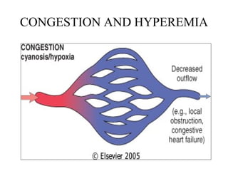 CONGESTION AND HYPEREMIA

 