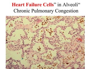 Heart Failure Cells” in Alveoli“
Chronic Pulmonary Congestion

 