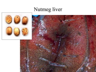 Nutmeg liver

 