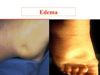 Edema

 