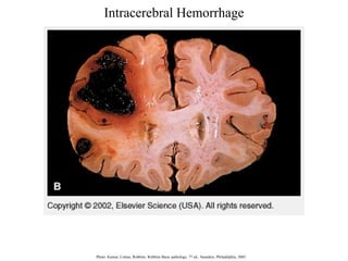 Intracerebral Hemorrhage

Photo: Kumar, Cotran, Robbins. Robbins Basic pathology, 7 th ed., Saunders, Philadelphia, 2003.

 