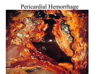 Pericardial Hemorrhage

 
