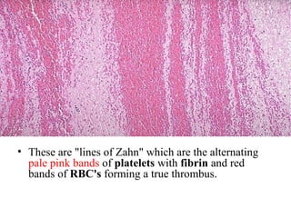 • These are "lines of Zahn" which are the alternating
pale pink bands of platelets with fibrin and red
bands of RBC's forming a true thrombus.

 
