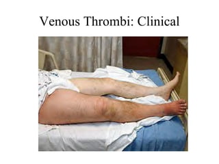 Venous Thrombi: Clinical

 