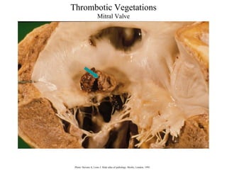 Thrombotic Vegetations
Mitral Valve

Photo: Stevens A, Lowe J. Slide atlas of pathology. Mosby, London, 1995.

 