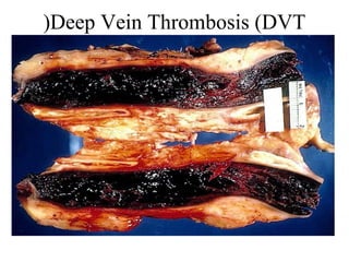 (Deep Vein Thrombosis (DVT

 