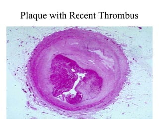 Plaque with Recent Thrombus

 