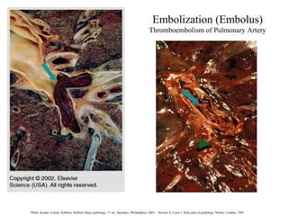 Embolization (Embolus(
Thromboembolism of Pulmonary Artery

Photo: Kumar, Cotran, Robbins. Robbins Basic pathology, 7 th ed., Saunders, Philadelphia, 2003; . Stevens A, Lowe J. Slide atlas of pathology. Mosby, London, 1995.

 