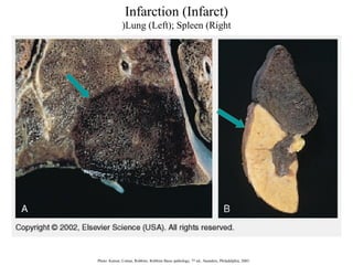 Infarction (Infarct(
(Lung (Left(; Spleen (Right

Photo: Kumar, Cotran, Robbins. Robbins Basic pathology, 7 th ed., Saunders, Philadelphia, 2003.

 