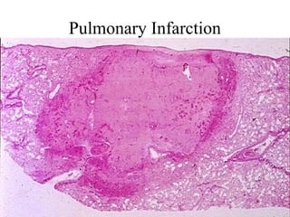 Pulmonary Infarction

 
