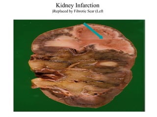 Kidney Infarction
(Replaced by Fibrotic Scar (Left

 