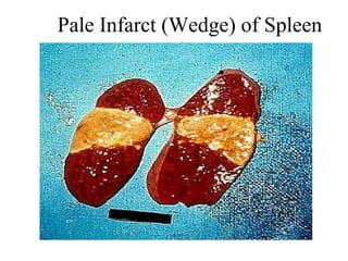 Pale Infarct (Wedge( of Spleen

 