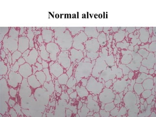 Normal alveoli

 