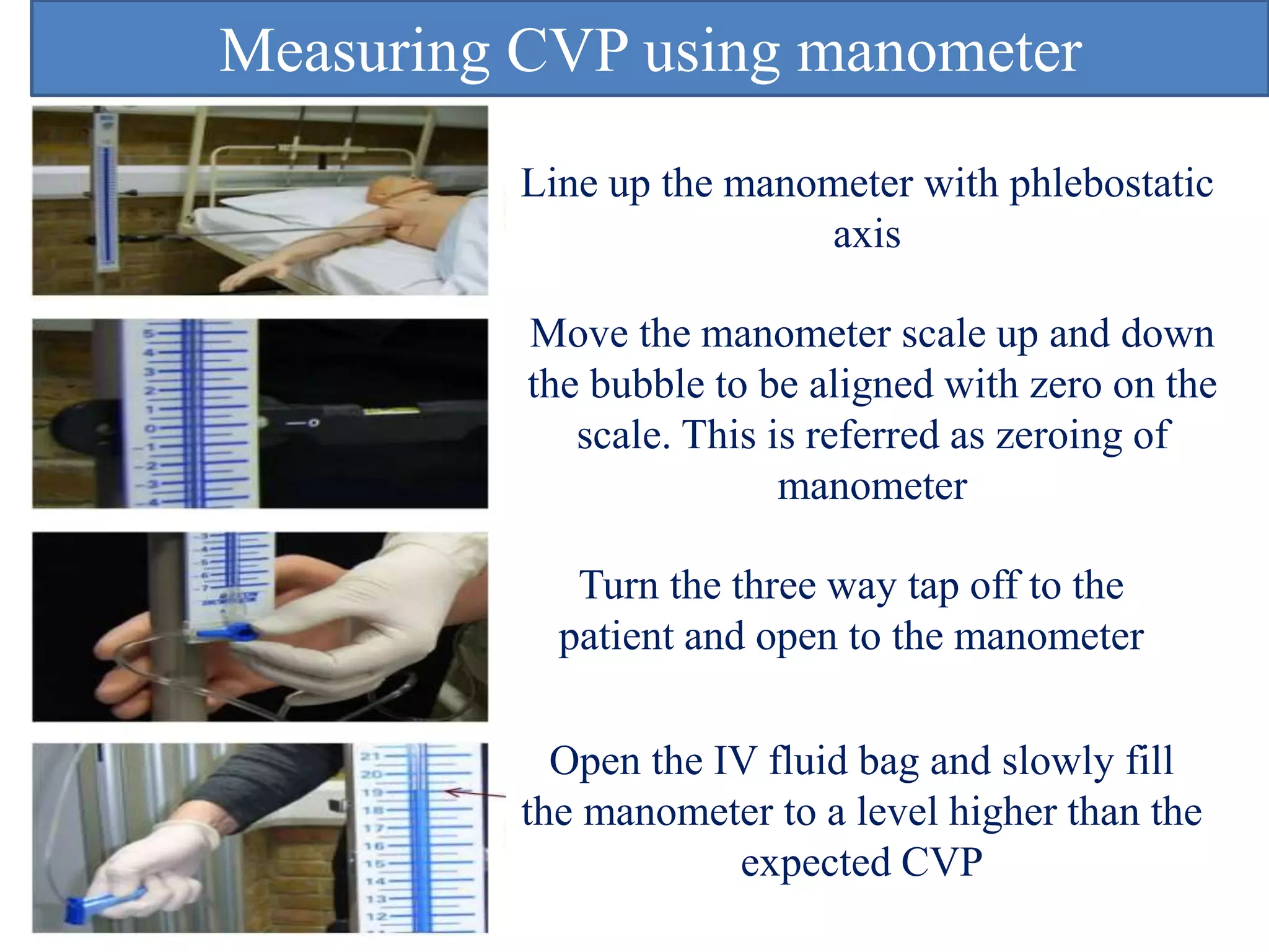 Line up the manometer with phlebostatic
axis
Move the manometer scale up and down
the bubble to be aligned with zero on the
scale. This is referred as zeroing of
manometer
Turn the three way tap off to the
patient and open to the manometer
Open the IV fluid bag and slowly fill
the manometer to a level higher than the
expected CVP
Measuring CVP using manometer
 