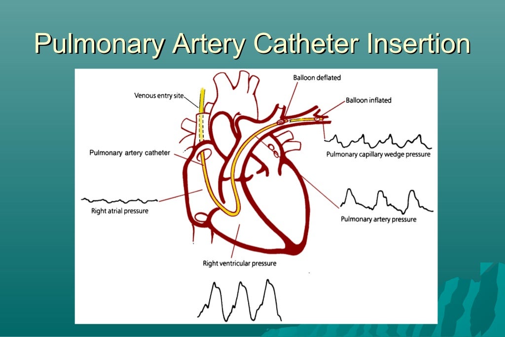 Hemodynamic monitoring