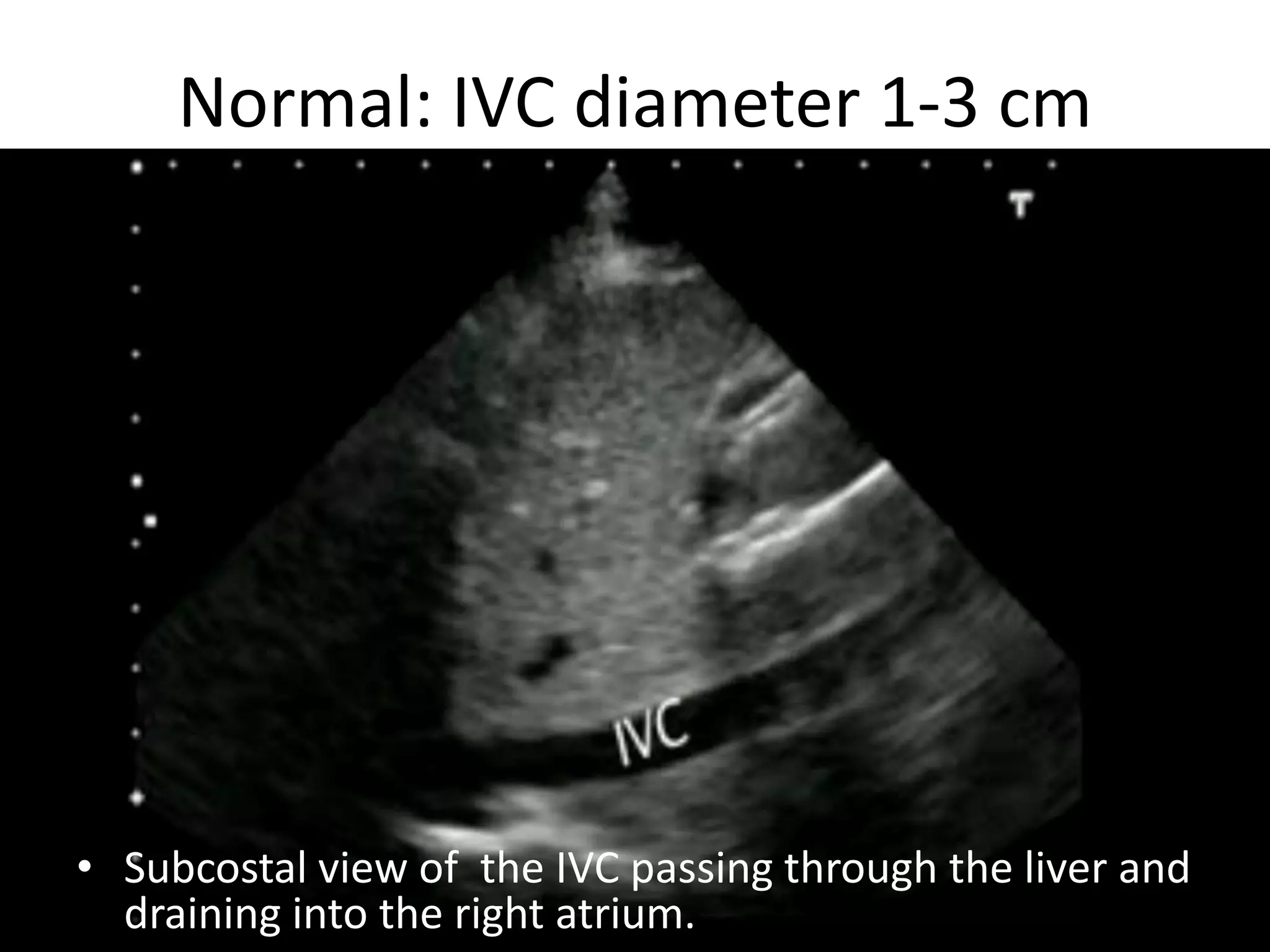 Normal: IVC diameter 1-3 cm

• Subcostal view of the IVC passing through the liver and
17
draining into the rightBassel Ericsoussi, MD
atrium.

 