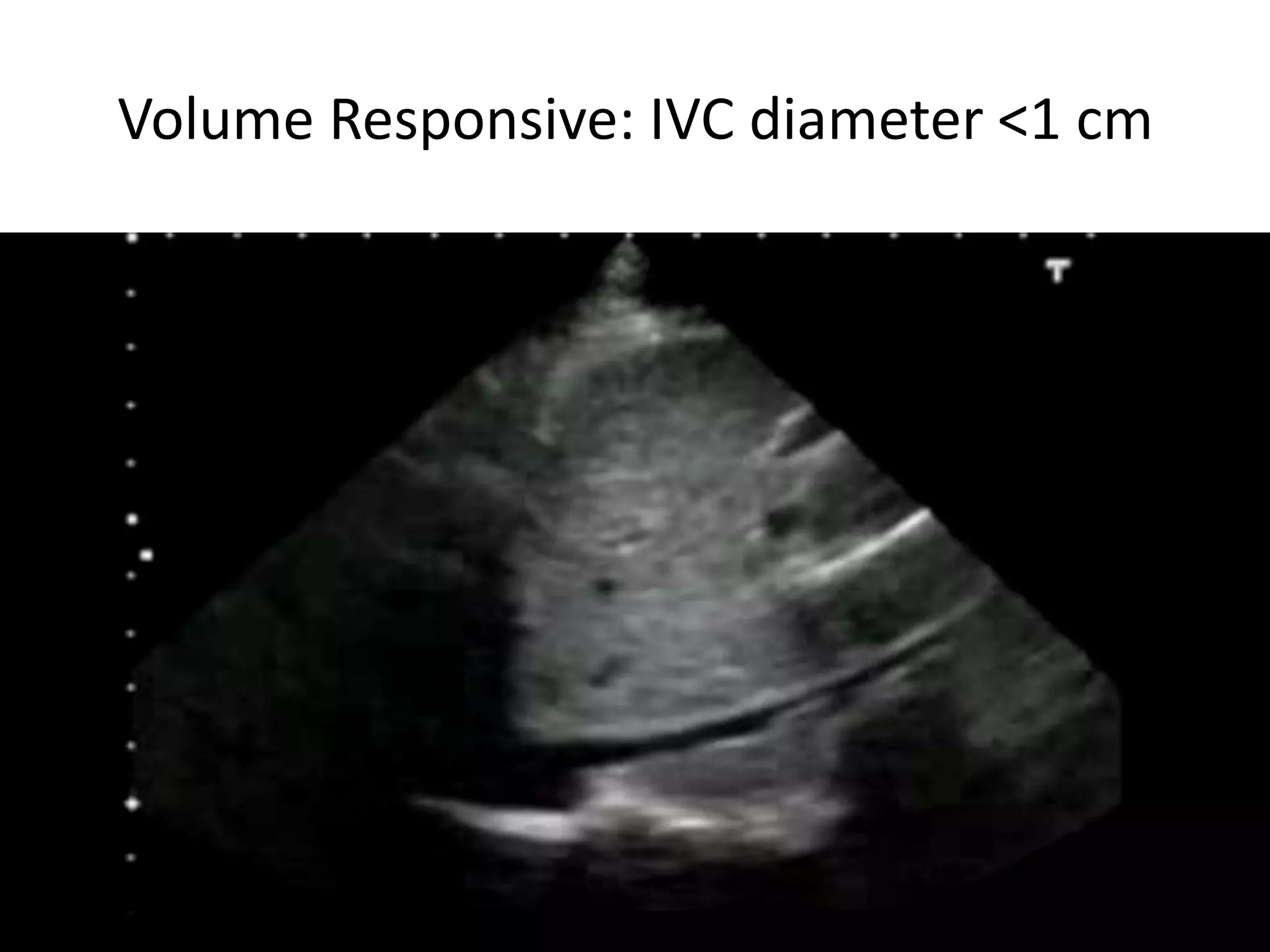 Volume Responsive: IVC diameter <1 cm

Bassel Ericsoussi, MD

18

 