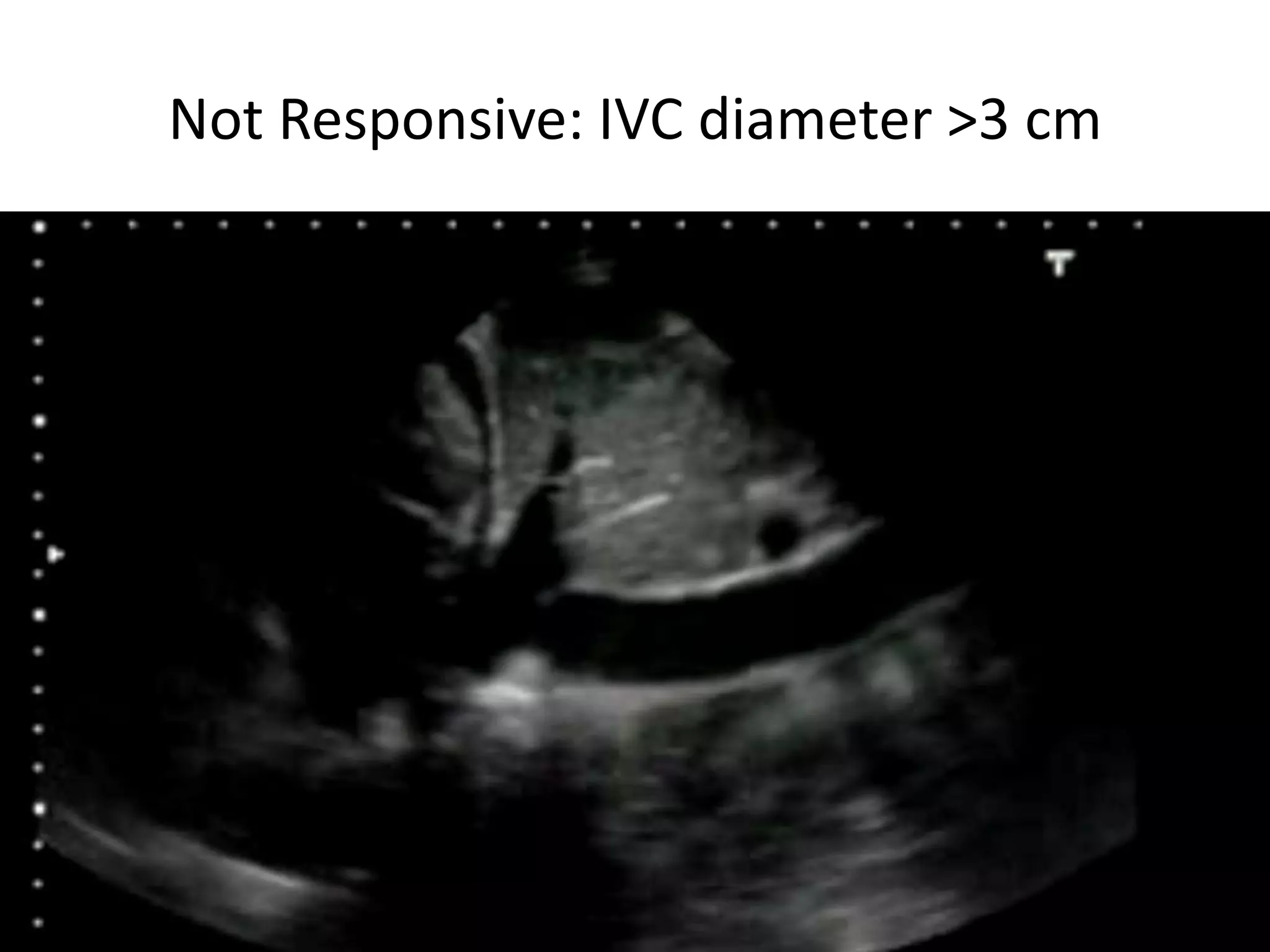 Not Responsive: IVC diameter >3 cm

Bassel Ericsoussi, MD

19

 