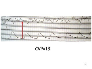 32
15
10
5
0
-5
CVP=13
 