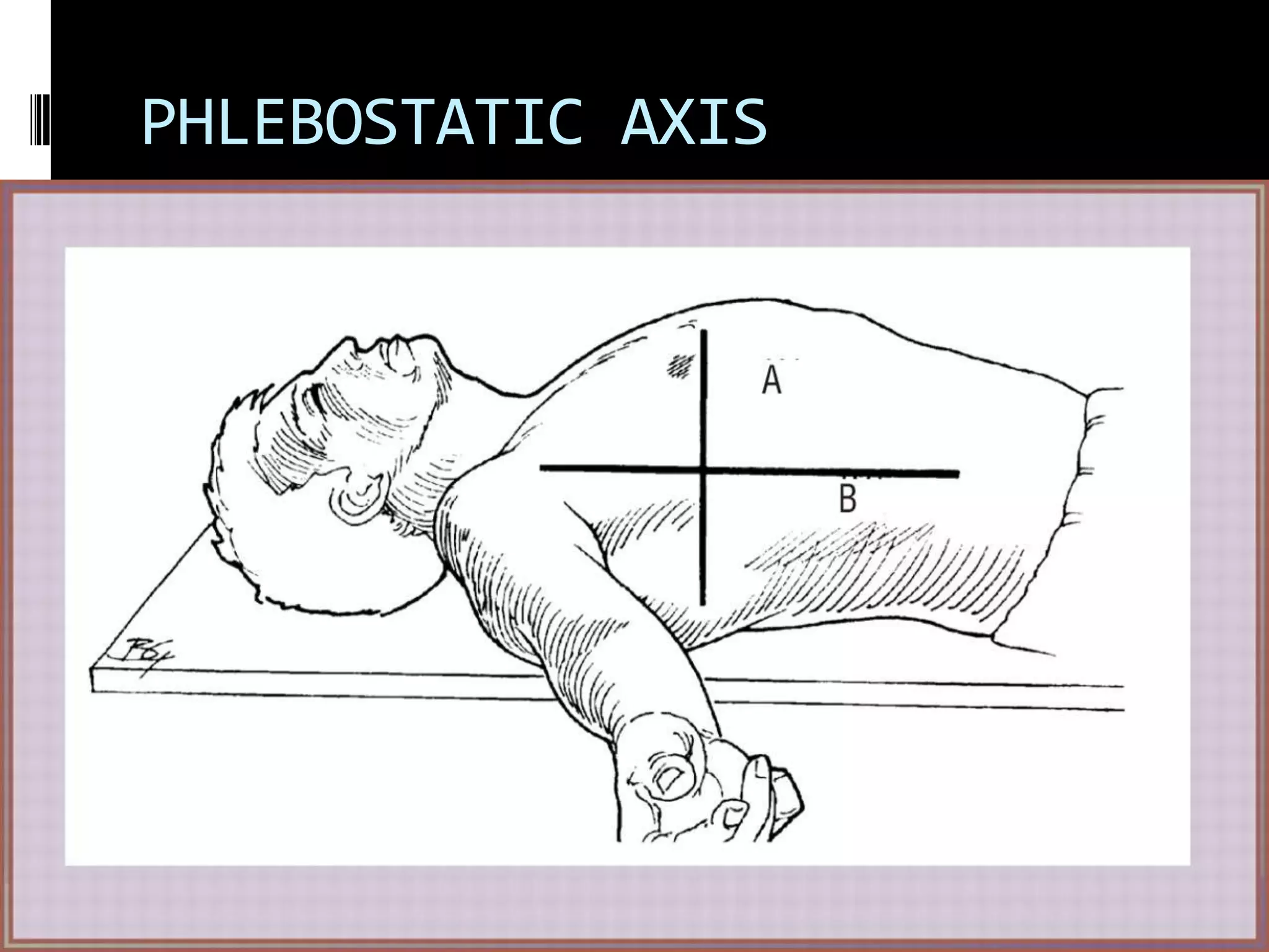 PHLEBOSTATIC AXIS

 
